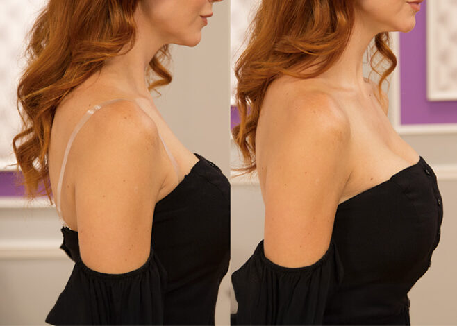 Kate Plastic Strap Profile BA 658x470